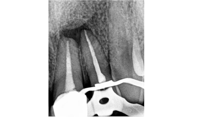 Résection-apicale-1.jpg