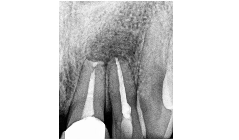 Résection-apicale-2.jpg